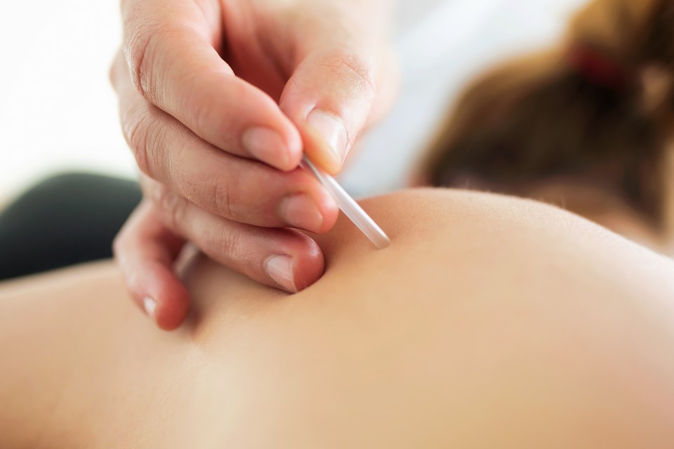 Dry Needling